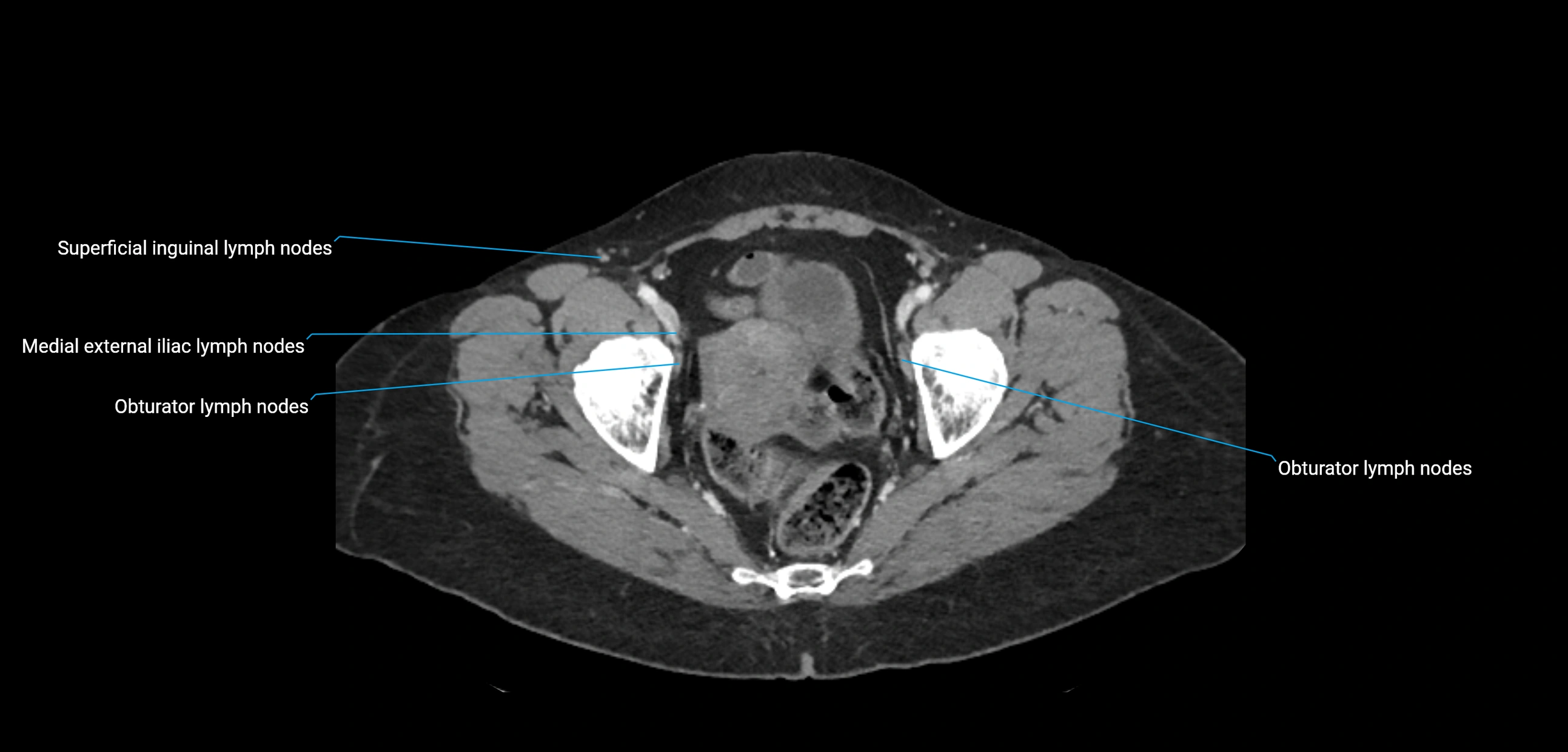 CT ct abdominal lymph nodes  axial cross sectional anatomy  enchanced radiology image -img-00002-00373.webp